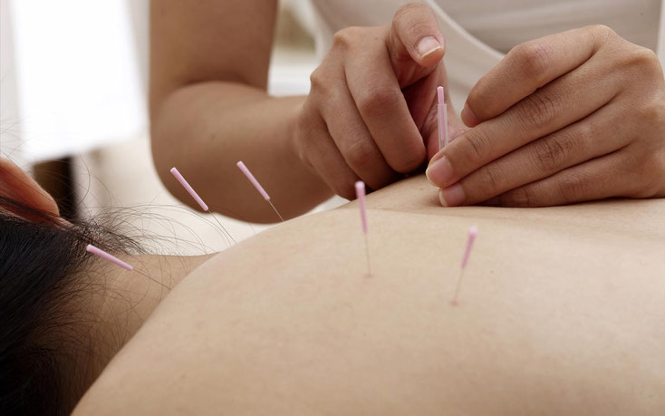 Acupuncture et migraine