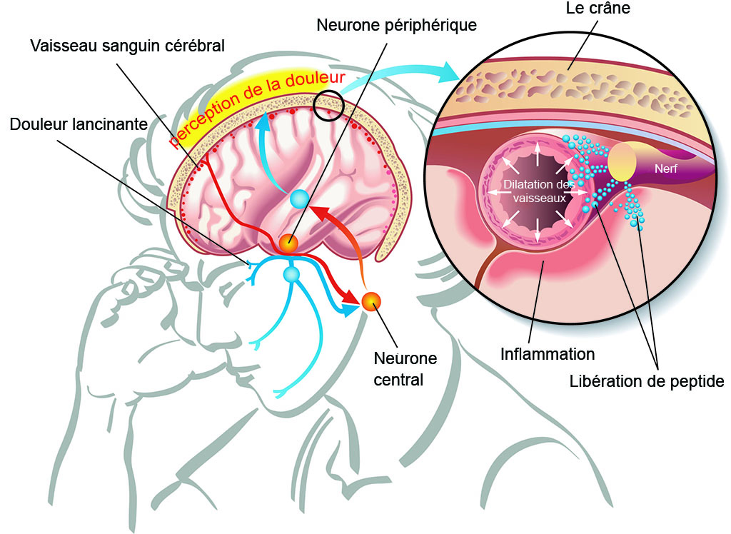 Quelles sont les conséquences neurologiques des troubles du