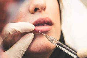 Injection dans la lèvre